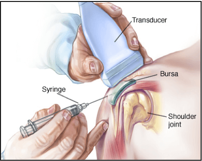 Centre Médical Plexus - Infiltrations